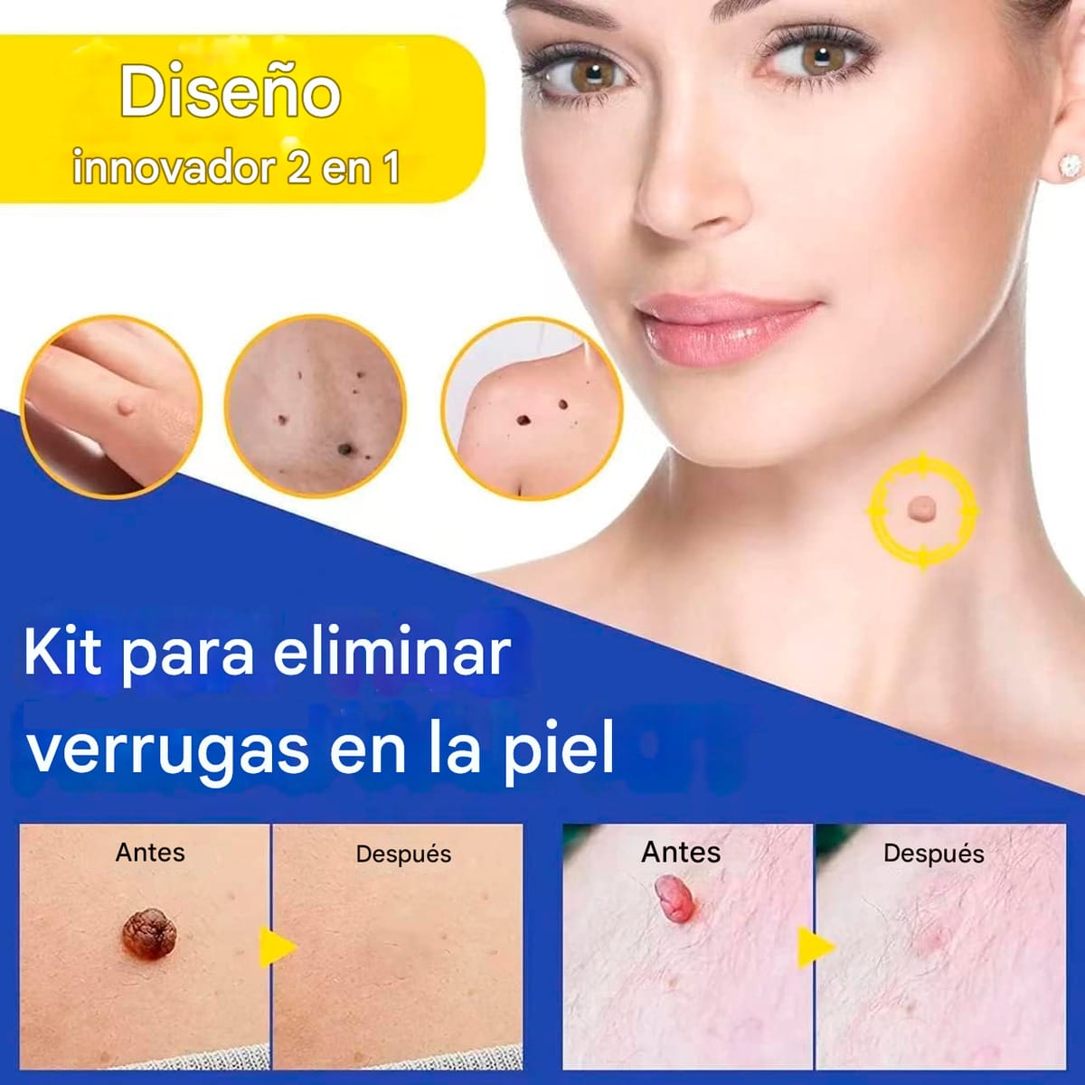 Kit De Eliminación Verrugas Lunares 40 Piezas Microetiquetas - Imagen 2
