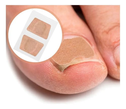 Parches Cuidado De Uñas Amarillas Cura Casera Para Hongos - Imagen 5